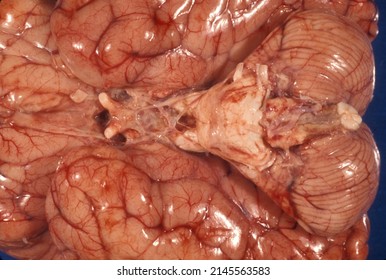 Gross Anatomy Of The Base Of A Human Brain. The Cerebellum, Medulla Oblongata, Pons, Optic Chiasm And Nerves Tract And Olfactory Tract Can Be Seen In The Midline. 