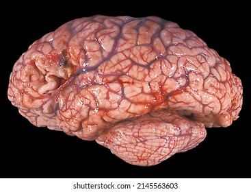 Gross anatomy of the lateral surface of a human brain showing a loss of substance in the frontal lobe. Leptomeninges have been removed from the area to show loss of substance in the cerebral cortex. 