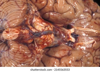 Gross Anatomy Of The Ventral Surface Of A Human Brain Showing Cerebellum, Medulla Oblongata, Pons (with Subarachnoid Diffuse Hemorrages), Optic Chiasm And Nerves Tract And Olfactory Tract And Bulb