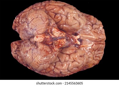 Gross Anatomy Of The Ventral Surface Of A Human Brain Showing Cerebellum, Medulla Oblongata, Pons (with Subarachnoid Diffuse Hemorrages), Optic Chiasm And Nerves Tract And Olfactory Tract And Bulb