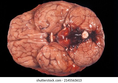 Gross anatomy of the ventral surface of a human brain showing an acute basal subarachnoid hemorrhage affecting the cerebellum base, medulla and pons.