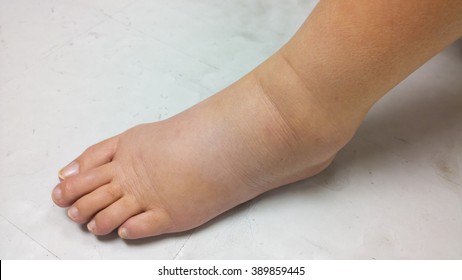 Gross Edema Of Leg And Foot