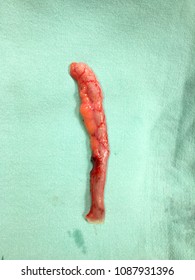 gross specimen of vermiform appendix after it was appendectomy due to acute appendicitis .