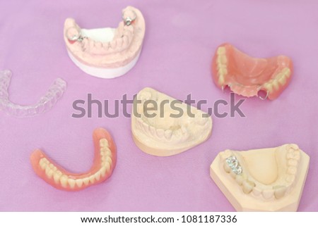group partial metal denture or removable prosthesis, Temporary plate
