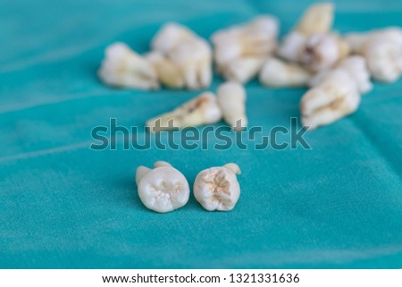 Group of teeth decay samples after tooth extraction. The most common reason comes from not brushing teeth and eating sweets. Soft focus and blur. Health and problem concept.