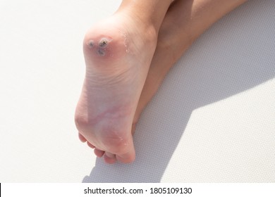 Group Of Warts On The Patient's Heel. White Background. Macro. Closeup. Concept For Treatment Of Viral Warts In Children, Hygiene, Human Skin Disease. Horizontal. Copy Space.