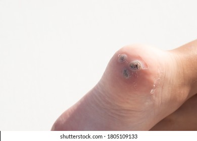 Group Of Warts On The Patient's Heel. White Background. Macro. Closeup. Concept For Treatment Of Viral Warts In Children, Hygiene, Human Skin Disease. Horizontal. Copy Space.