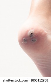 Group Of Warts On The Patient's Heel. White Background. Macro. Closeup. Concept For Treatment Of Viral Warts In Children, Hygiene, Human Skin Disease. Vertical. Copy Space.