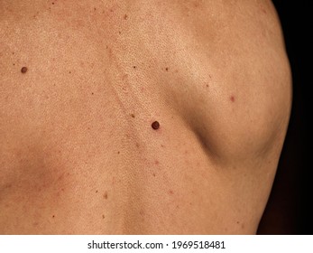 Growing Red Mole On Man's Back. Skin Cancer Symptom.