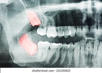 Growing Wisdom Teeth Pain On X-Ray - Shutterstock ID 231350425