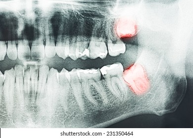 Growing Wisdom Teeth Pain On X-Ray