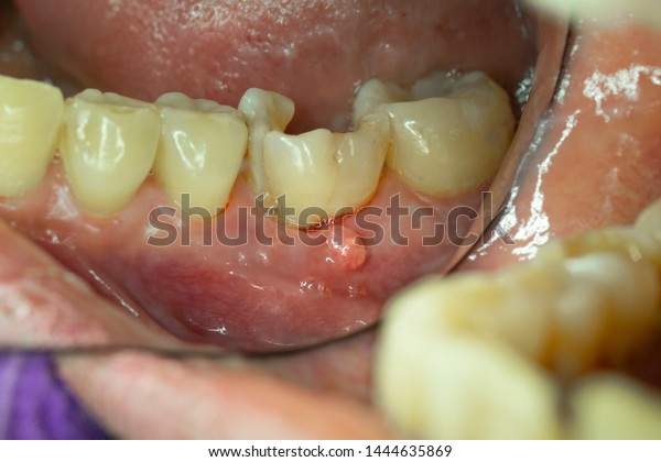 Gum Abscess Tooth Infection Stock Photo (Edit Now) 1444635869