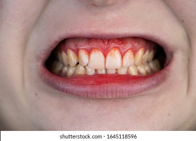 Zahnfleischbluten und Entzündungen, Nahaufnahme. Ein Mann, der von einem Zahnarzt untersucht wurde. Die Diagnose einer Gingivitis