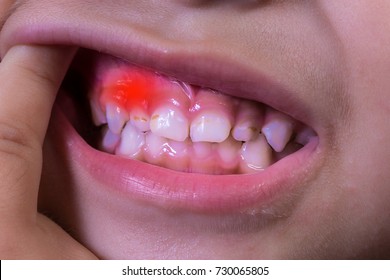 Gum Disease In Children