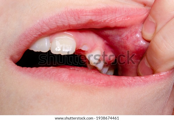 Gum Disease Tooth Decay Child Stock Photo (Edit Now) 1938674461