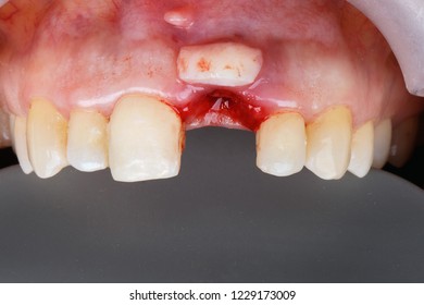 Gum Graft Of Soft Tissue After Implantation