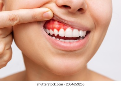 Gum inflammation. Cropped shot of a young woman showing bleeding gums isolated on a white background. Dentistry, dental care	 - Shutterstock ID 2084653255