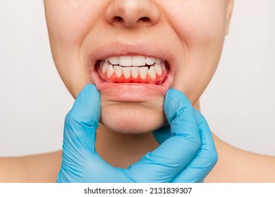 Gum inflammation. Cropped shot of a young woman's face with doctor's hand in a blue glove showing red bleeding gums isolated on a white background. Examination at the dentist. Dentistry, dental care