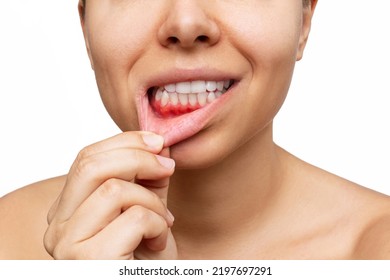 Inflamación de la goma. La imagen recortada de una joven muestra encías sangrantes rojas que tiran del labio aisladas en un fondo blanco. Cierra. Odontología, odontología