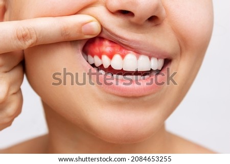 Gum inflammation. Cropped shot of a young woman showing bleeding gums isolated on a white background. Dentistry, dental care	 Stockfoto © 