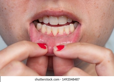 Gum Recession After A Frenectomy