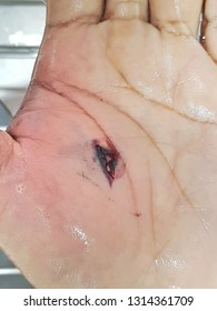 Gunshot Wound On Hand