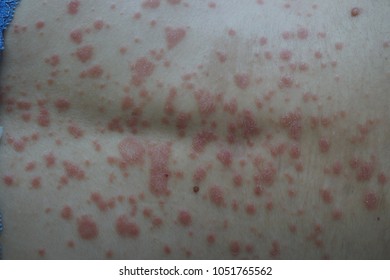 Guttate Psoriasis On The Back