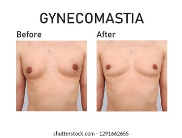 Gynecomastia. Before And After Surgery