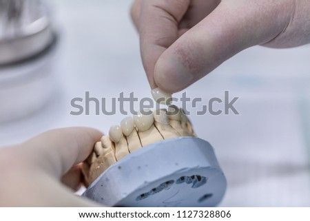 Gypsum Stomatologic human jaws. Ceramic-metal crown on plaster model