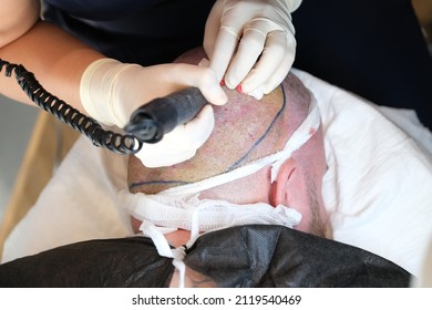 Hair bulb transplanted into a hairless area.Surgical technique that moves.