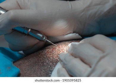 Hair Implant Process, Collecting Hair Plasma For Implanting Process