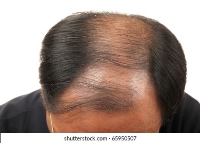 Hair Loss