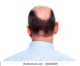 Hair loss. Bald man. Isolated on white background.