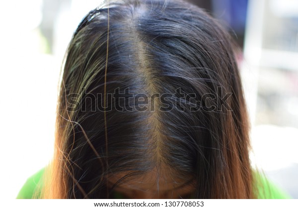 Hair Loss Baldness Dandruff On Scalp People Backgrounds