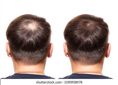 hair loss. Care Concept. transplantation hair. men view from the back, comparison of hair before and after transplantation. bald head.  baldness treatment. medicine. thick healthy hair. head          