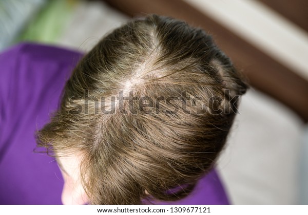 Hair Loss Female Alopecia Areata Stock Photo Edit Now 1309677121