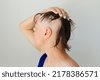alopecia stress