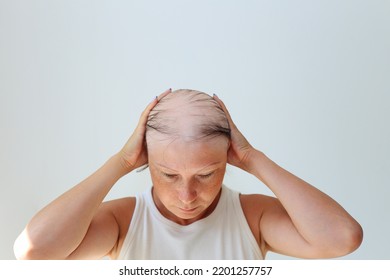 Hair Loss In The Form Of Alopecia Areata. Bald Head Of A Woman. Hair Thinning After Covid. Bald Patches Of Total Alopecia