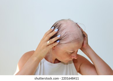 Hair Loss In The Form Of Alopecia Areata. Bald Head Of A Woman. Hair Thinning After Covid. Bald Patches Of Total Alopecia