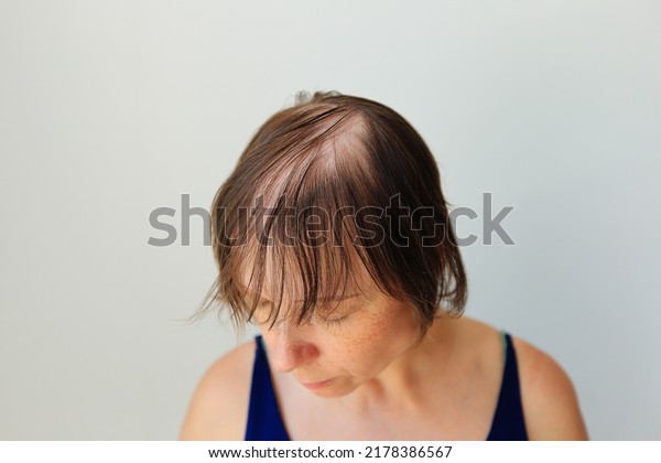 Hair\
loss in the form of alopecia areata. Bald head of a woman. Hair\
thinning after covid. Bald patches of total\
alopecia