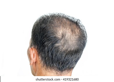 hair loss, Male head with hair loss symptoms back side, glabrous