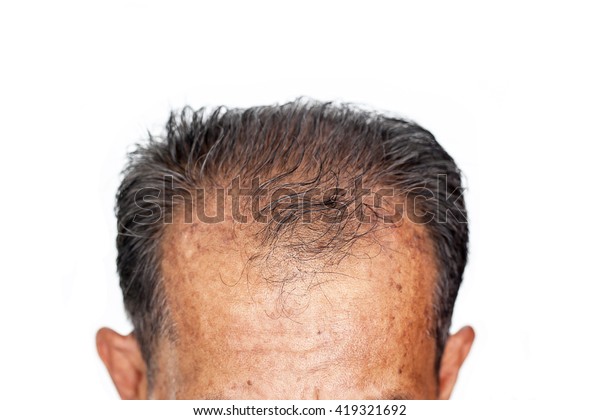 Hair Loss Male Head Hair Loss Stock Photo Edit Now 419321692