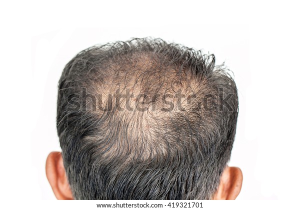 Hair Loss Male Head Hair Loss Stock Photo Edit Now 419321701
