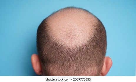 Hair loss in men. Bald head of an adult man from the back. Alopecia on the head.