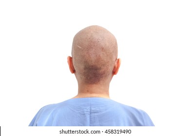 Hair Loss Patient After Chemotherapy On White Background Isolated