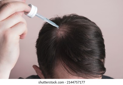 Hair loss problem. Man applying dropper with minoxidil or serum. Baldness treatment concept, genetic alopecia. Closeup, top view - Shutterstock ID 2144757177