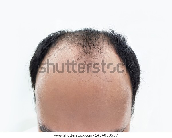 Hair Loss Problems Glabrous Close Bald Royalty Free Stock Image
