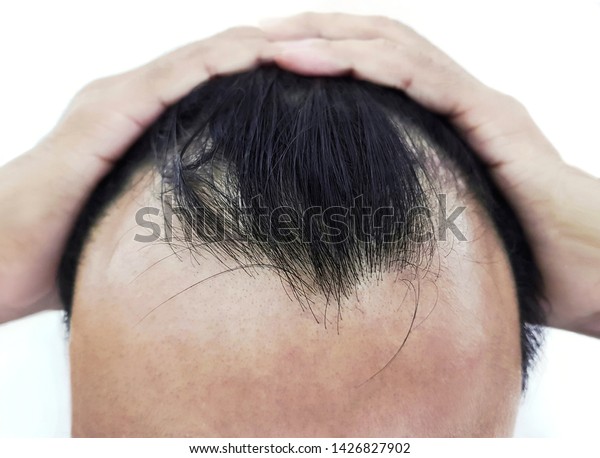 Hair Loss Problems Man Worry Use Royalty Free Stock Image