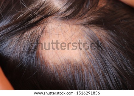 Hair loss in scalp. Patchy hair loss patter.
