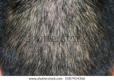 Hair loss in secondary syphilis stage, alopecia, which is nonscarring, can occasionally affect hair-bearing areas other than the scalp.